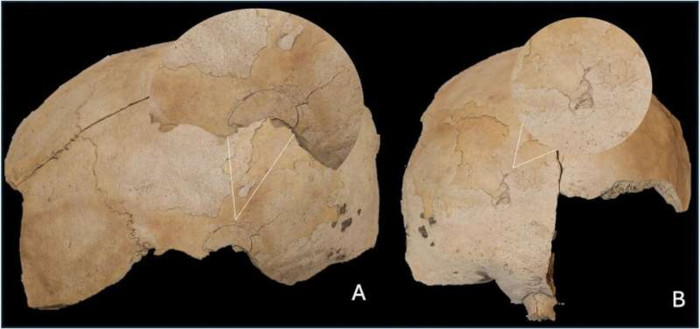 Incomplete cranium with two blunt force injuries, deposited in a pit rather than a grave