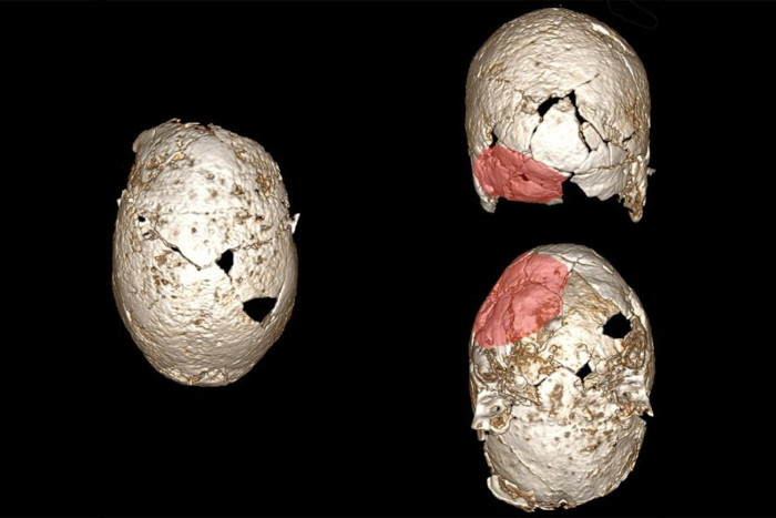 CT scans of a Matelica cranium, with the flattened area highlighted in red