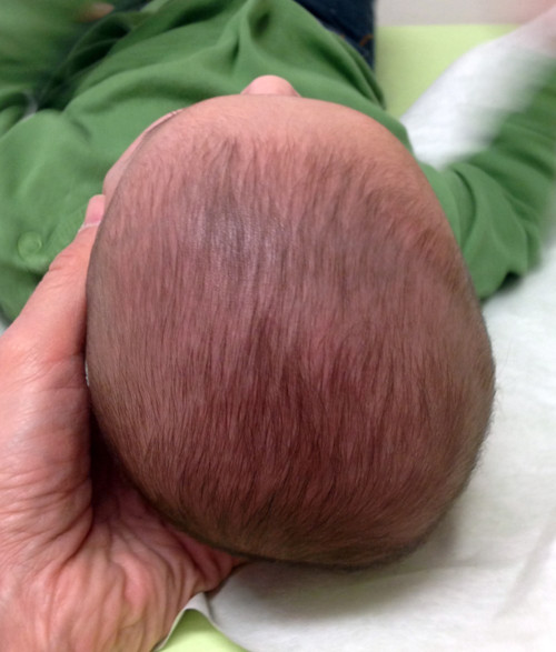 The flattened back of an infant's head