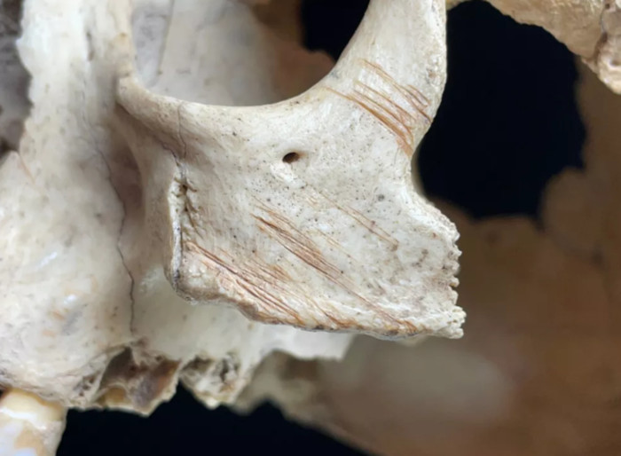 ut marks cross the zygomatic, or cheekbone